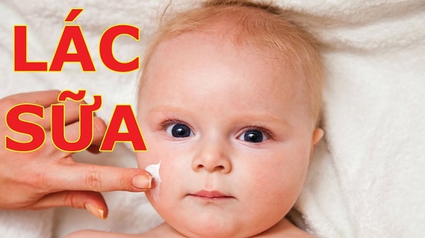 Bệnh chàm sữa trẻ em