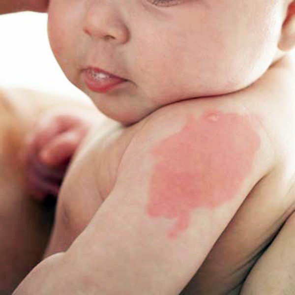 Cách điều trị bệnh chàm trẻ em