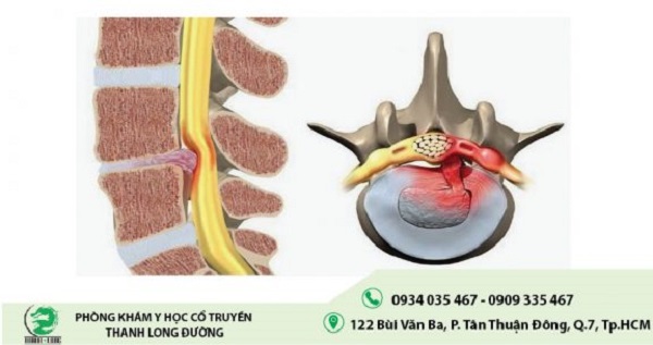 thoat-vi-dia-dem-mat-nuoc