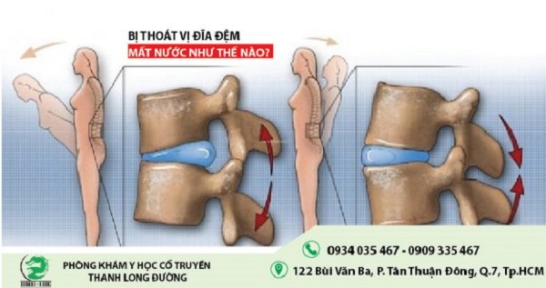 benh-thoat-vi-dia-dem-mat-nuoc